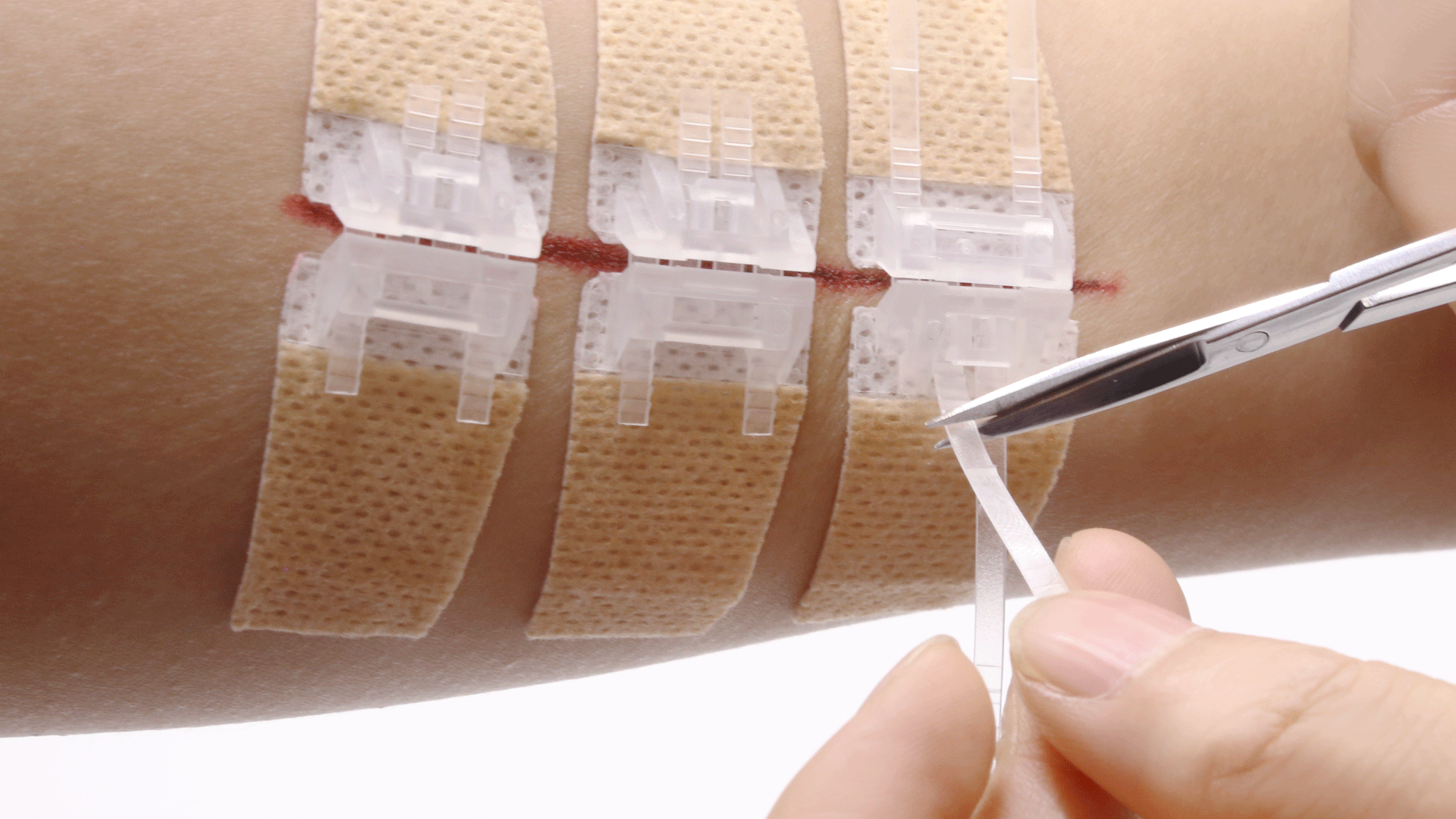 Wound Closure Device image cover